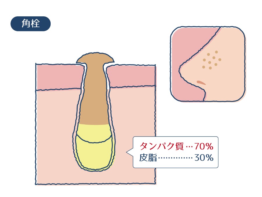 角栓の成分割合を示す図