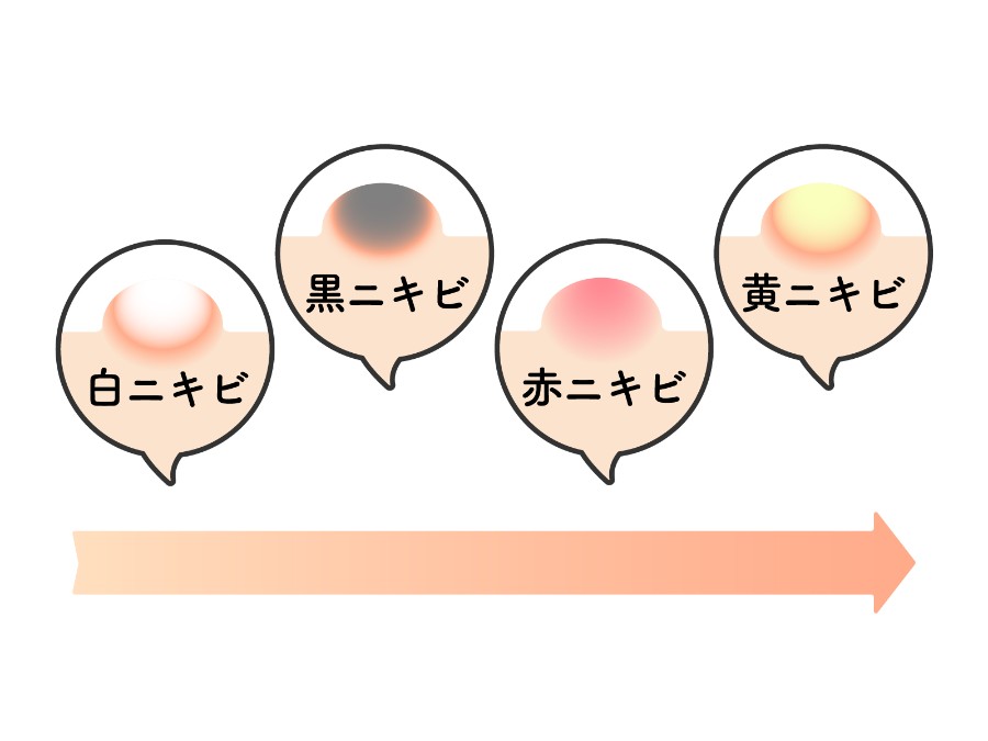 ニキビの種類を説明するイラスト
